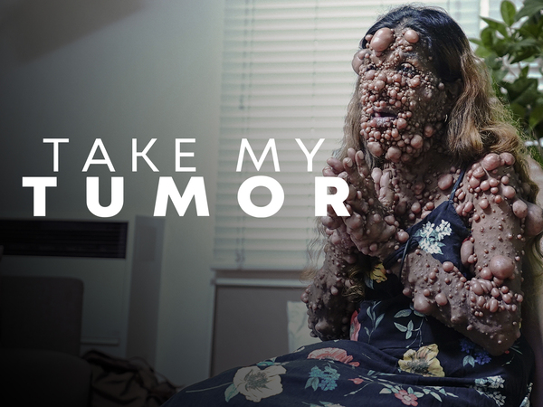 Take My Tumor